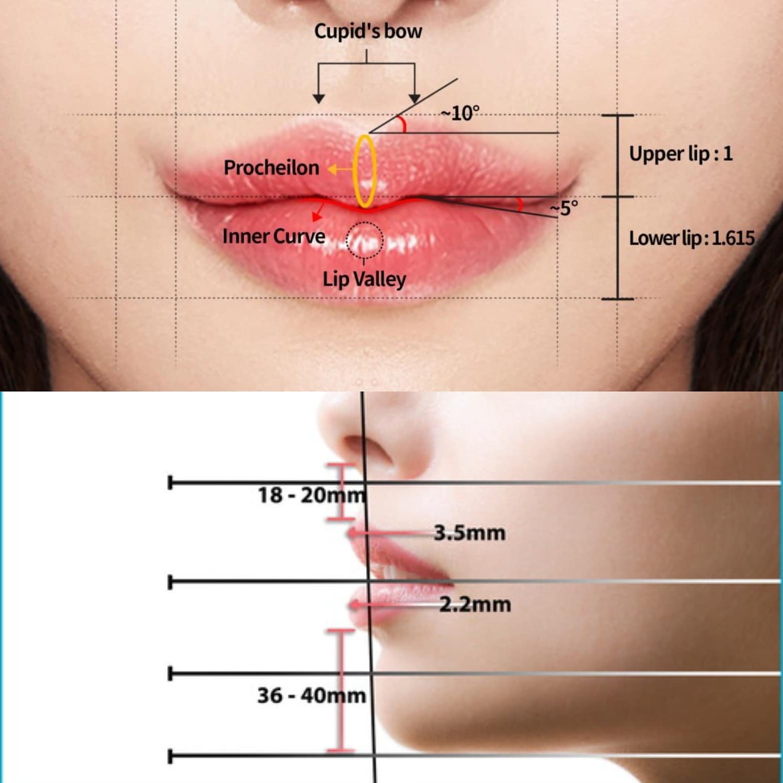 Lifting de lèvre - Chirurgie esthétique et plastique Genève