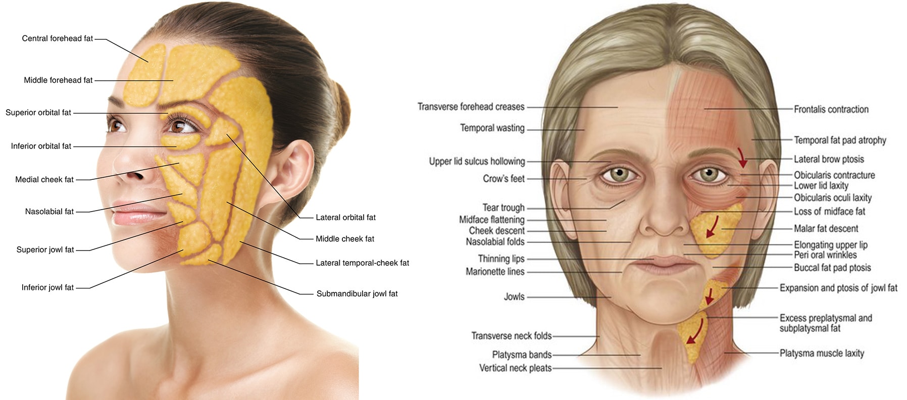 Rajeunissement du visage par lipofilling Genève