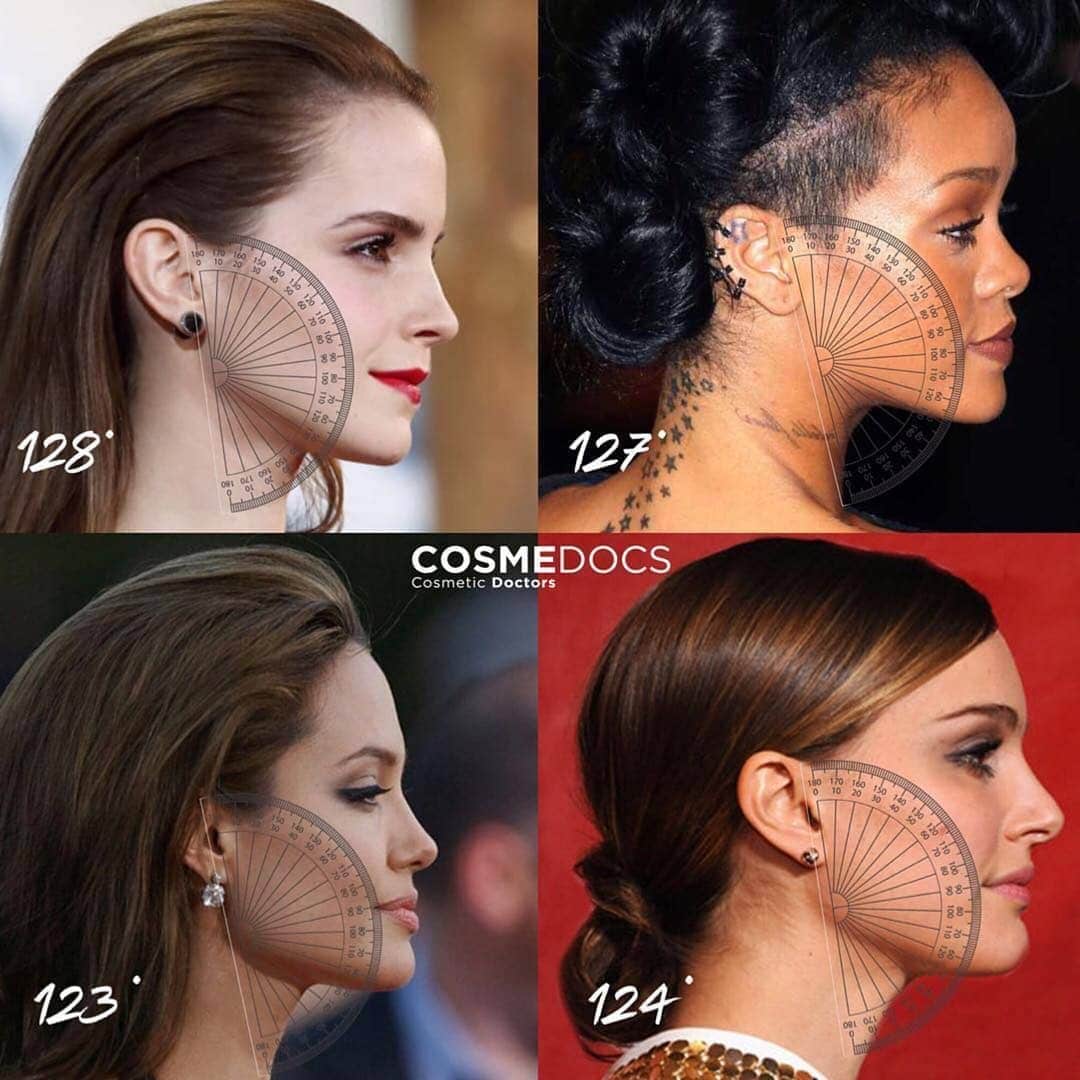 Jawline contouring par acide hyaluronique Genève