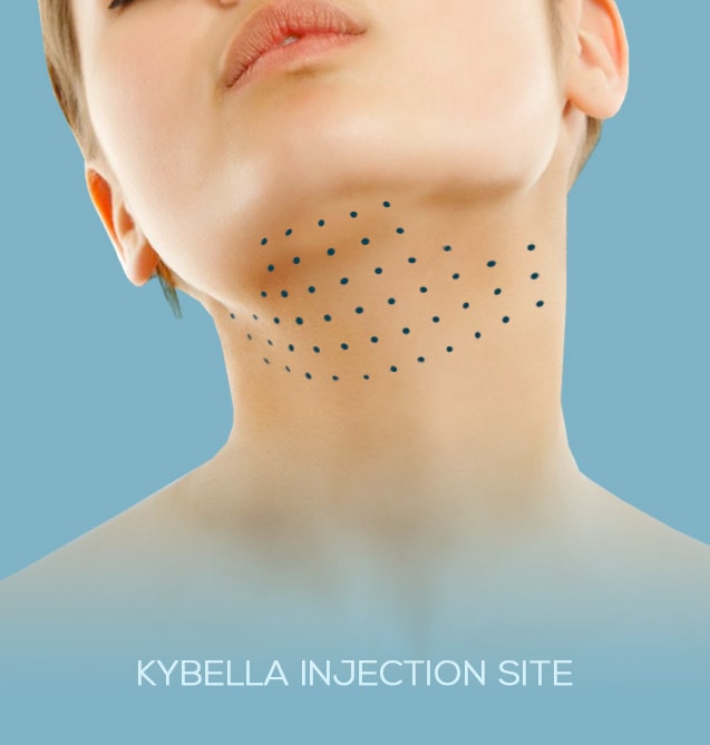 Kybella ® for double chin Geneva Dr Lucas Plastic Surgery