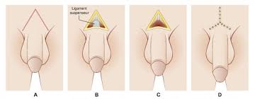 Augmentation du pénis par section du ligament suspenseur