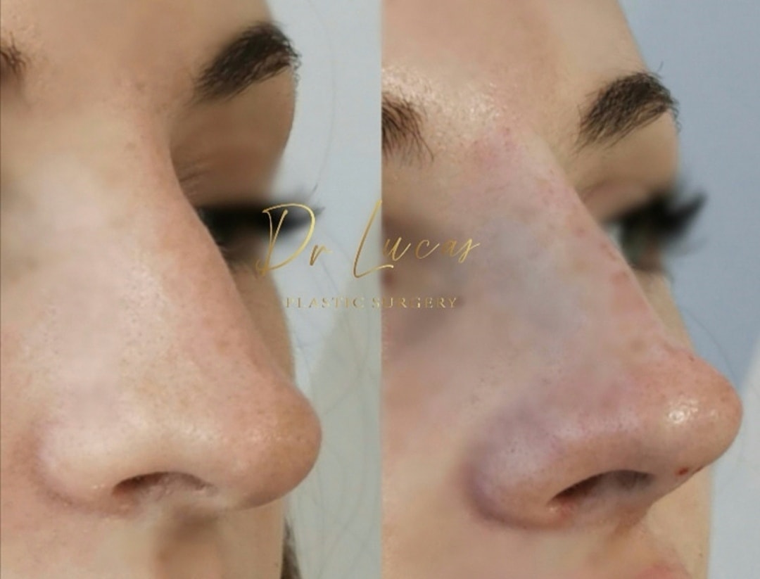 Thread Absorbable Rhinoplasty Medical rhinoplasty by hyaluronic acid or threads in Geneva