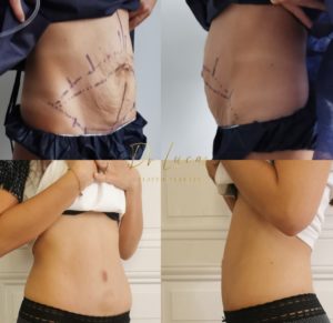 Abdominoplasty Surgery in Geneva by Dr Lucas Plastic Surgery