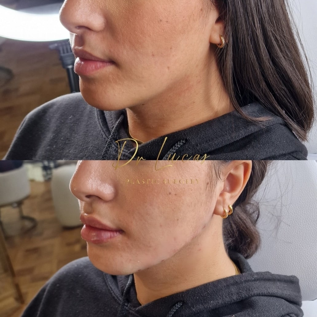Jawline contouring par acide hyaluronique Genève Dr Lucas