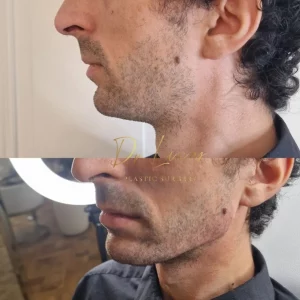 Jawline contouring par acide hyaluronique Genève